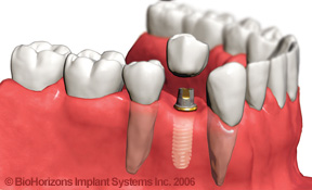 Close up of a tooth implant being surgically implanted into the jaw of patient near Palm Harbor and Trinity.