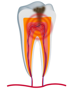 endodontics and root canals with a Palm Harbor dentist New Port Richey