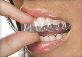 get beautiful straight teeth with a Trinity dentist New Port Richey