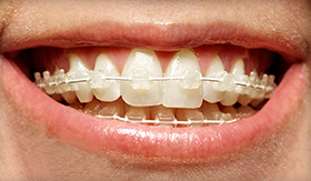 clear braces for adults with a Palm Harbor dentist New Port Richey