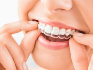 Close up photo of Candid teeth aligners straightening teeth.