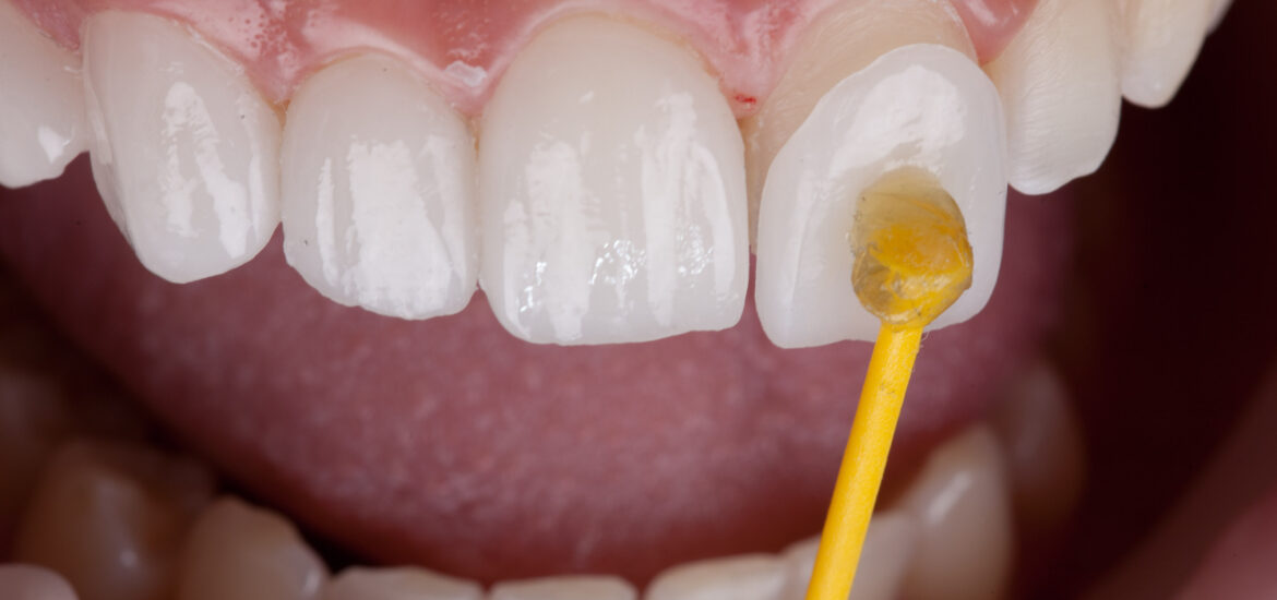 up close application of dental veneers