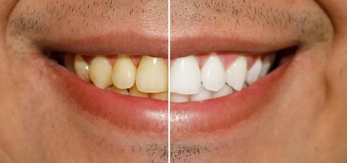 Teeth before and after whitening in Palm Harbor, FL